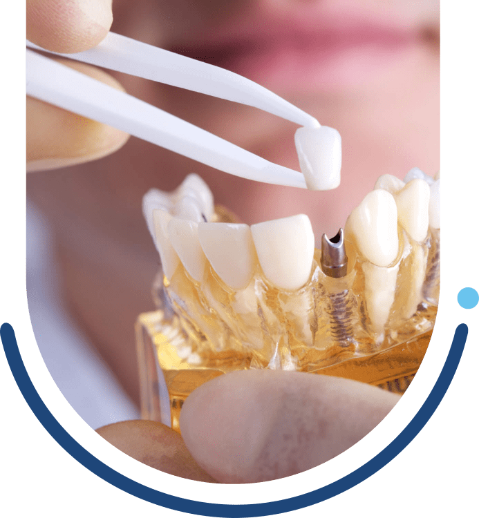 Implante dentário em Salvador