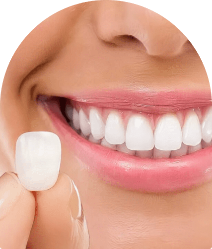 Lente de contato dental em Salvador